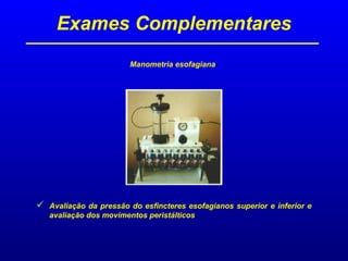Exames Complementares
Manometria esofagiana
 Avaliação da pressão do esfincteres esofagianos superior e inferior e
avaliação dos movimentos peristálticos
 