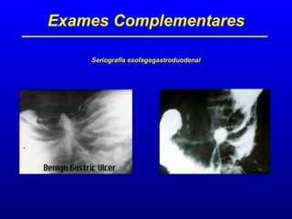 Exames Complementares
Seriografia esofagogastroduodenal
Exames Complementares
 