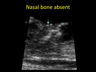 1-fetal genetic ultrasound Dr Ahmed Esawy | PDF