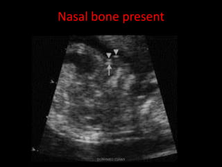 1-fetal genetic ultrasound Dr Ahmed Esawy | PDF