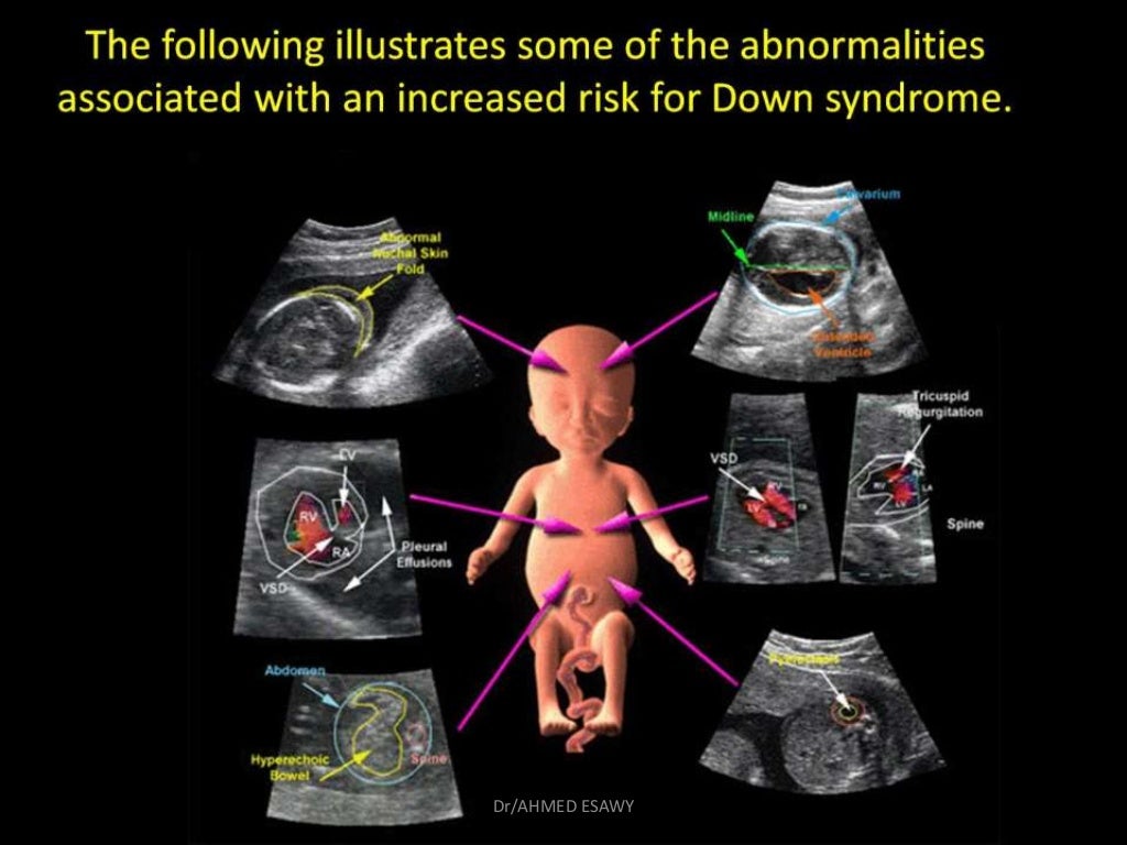 1fetal ultrasound Dr Ahmed Esawy