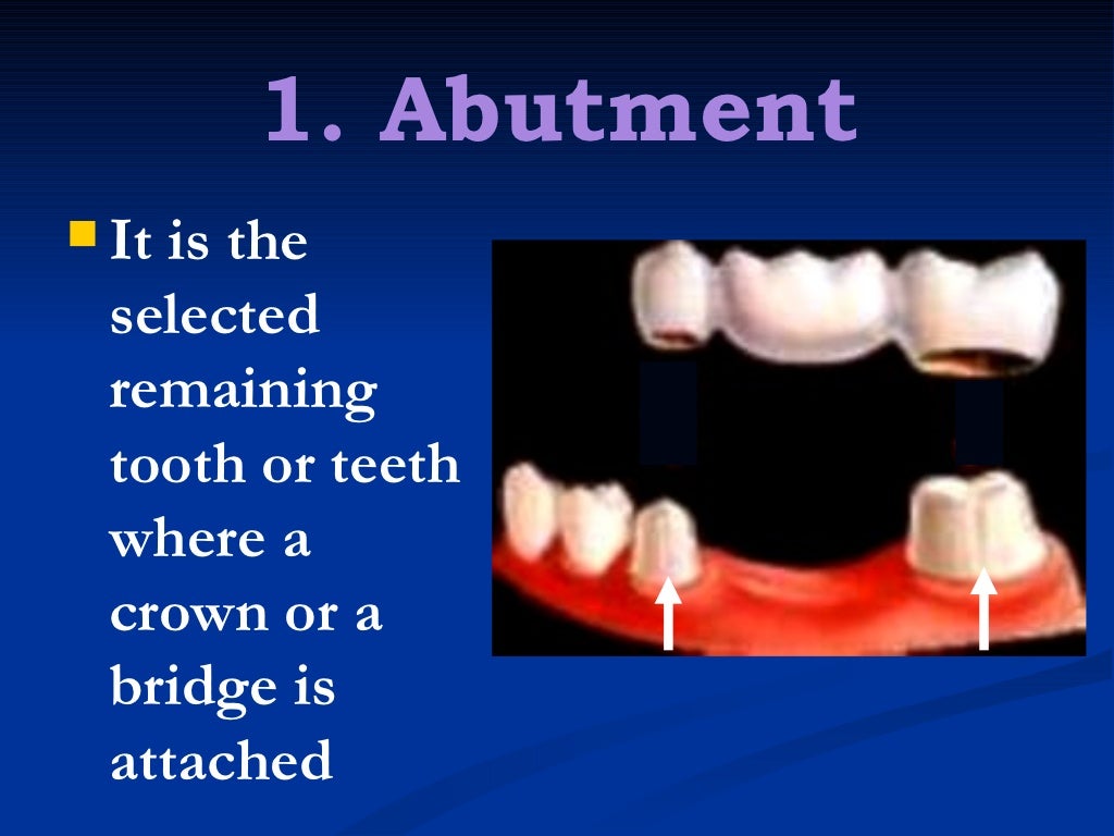 1. fixed partial denture finals1