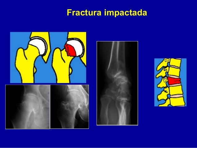 1 fracturas generalidades 1 fracturas generalidades
