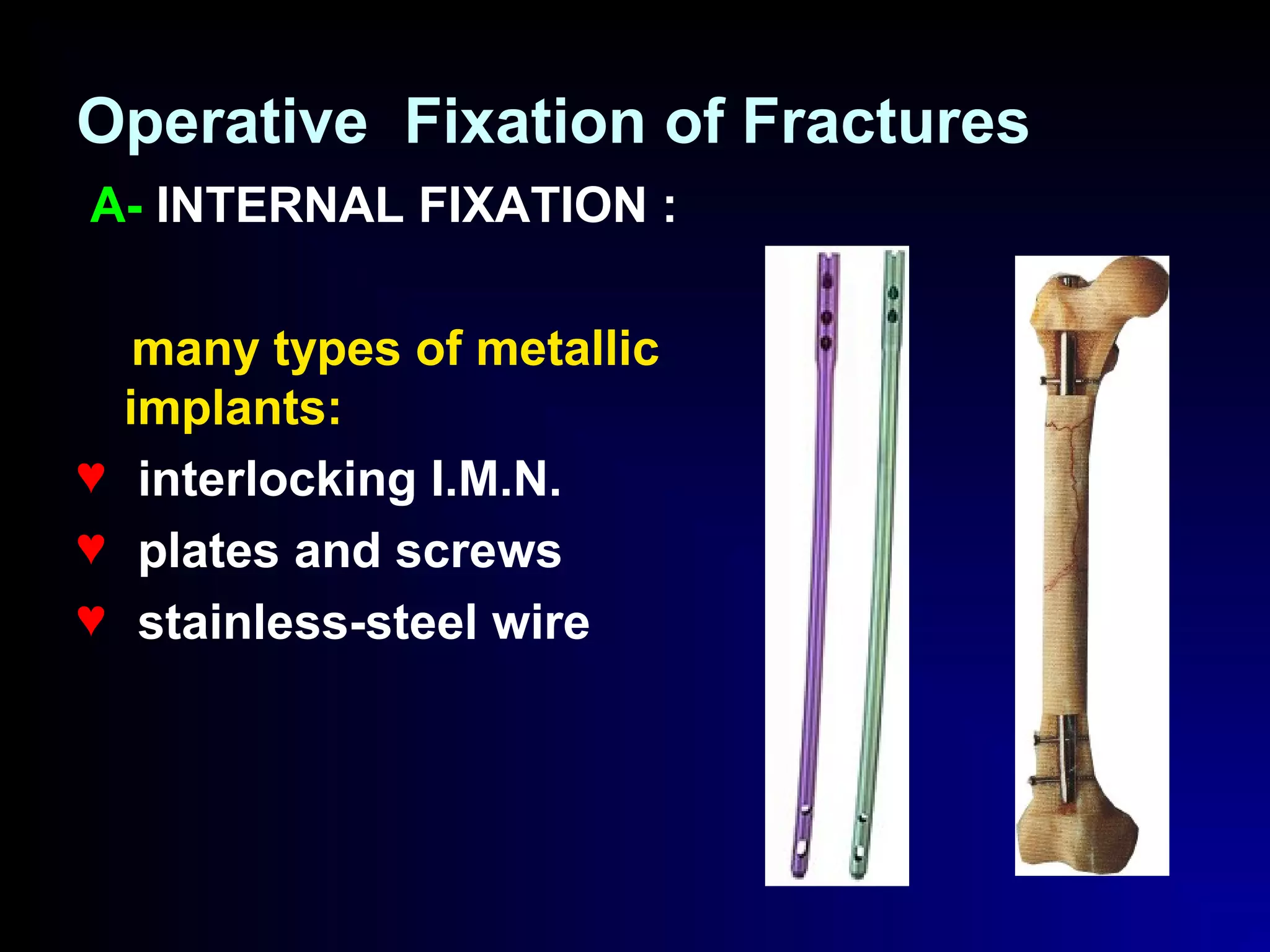 Introduction to Fractures | PPT