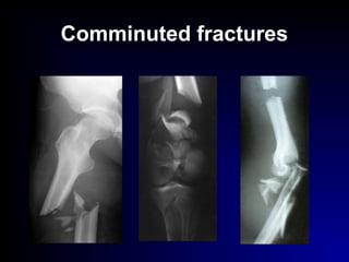 Comminuted fractures
 