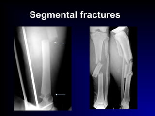 Segmental fractures
 