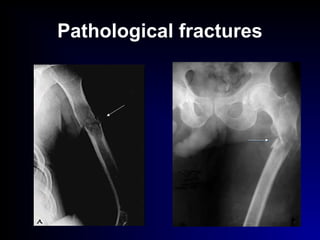 Pathological fractures
 