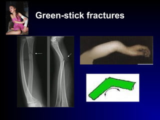 Green-stick fractures
 