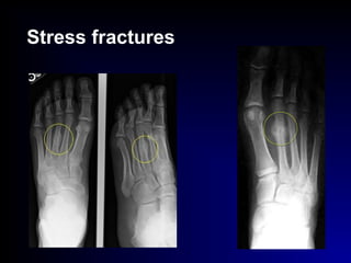 Stress fractures
 