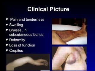 Clinical Picture
♥ Pain and tenderness
♥ Swelling
♥ Bruises, in
subcutaneous bones
♥ Deformity
♥ Loss of function
♥ Crepitus
 
