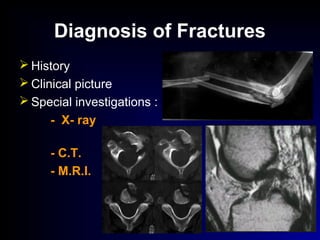 Diagnosis of Fractures
 History
 Clinical picture
 Special investigations :
- X- ray
- C.T.
- M.R.I.
 