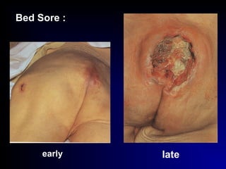 Bed Sore :
early late
 