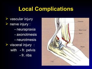 Local Complications
 vascular injury
 nerve injury :
- neurapraxia
- axonotmesis
- neurotmesis
 visceral injury :
with - fr. pelvis
- fr. ribs
 