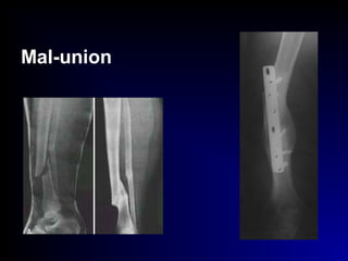 Mal-union
 
