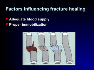 Factors influencing fracture healing
♥ Adequate blood supply
♥ Proper immobilization
 