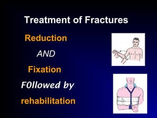 Treatment of Fractures
Reduction
AND
Fixation
F0llowed by
rehabilitation
 