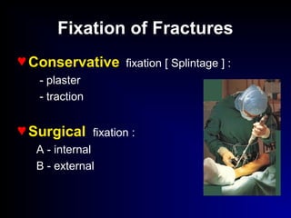 Fixation of Fractures
♥ Conservative fixation [ Splintage ] :
- plaster
- traction
♥ Surgical fixation :
A - internal
B - external
 