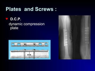 Plates and Screws :
♥ D.C.P.
dynamic compression
plate
 