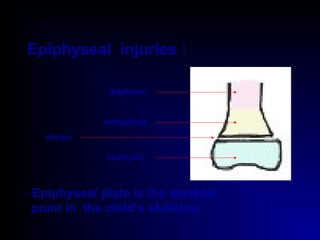 Epiphyseal injuries :
epiphysis
metaphysis
diaphysis
physis
- Epiphyseal plate is the weakest
point in the child’s skeleton
 