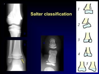 Salter classification
2
3
4
 