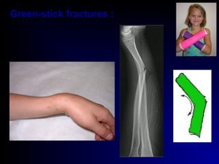 Green-stick fractures :
 
