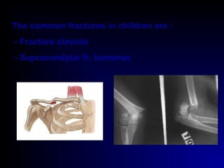 The common fractures in children are :
- Fracture clavicle
- Supracondylar fr. humerus
 