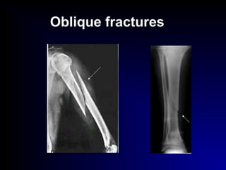 Oblique fractures
 