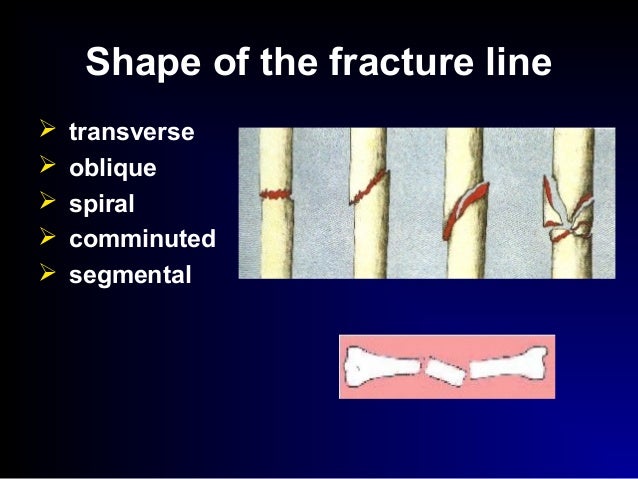 Spiral Fracture Definition Staff Nurse Vacancy Fractures Types 