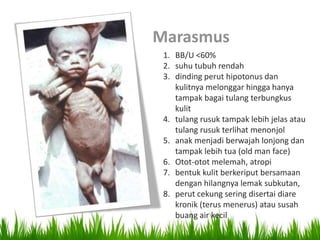 Marasmus
 1. BB/U <60%
 2. suhu tubuh rendah
 3. dinding perut hipotonus dan
    kulitnya melonggar hingga hanya
    tampak bagai tulang terbungkus
    kulit
 4. tulang rusuk tampak lebih jelas atau
    tulang rusuk terlihat menonjol
 5. anak menjadi berwajah lonjong dan
    tampak lebih tua (old man face)
 6. Otot-otot melemah, atropi
 7. bentuk kulit berkeriput bersamaan
    dengan hilangnya lemak subkutan,
 8. perut cekung sering disertai diare
    kronik (terus menerus) atau susah
    buang air kecil
 