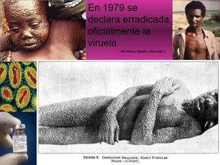En 1979 se declara erradicada oficialmente la viruela Ali Maow Maalin (Somalia ) 
