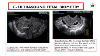 Gs Measure ESTIMATION OF GESTATIONAL AGE | PDF