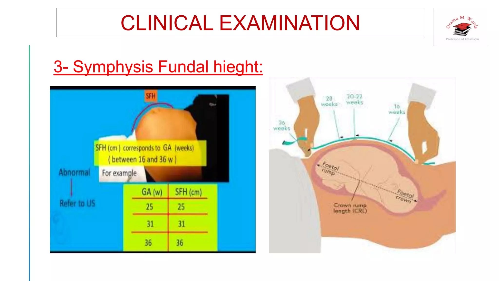 CLINICAL EXAMINATION
3- Symphysis Fundal hieght:
 