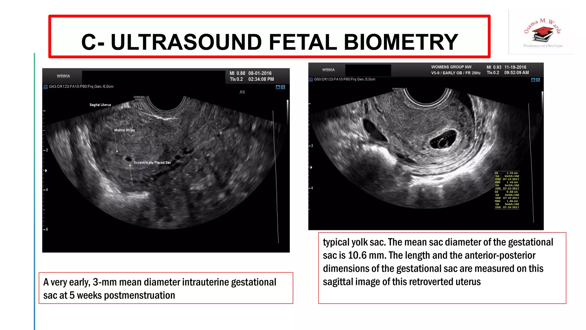 A very early, 3-mm mean diameter intrauterine gestational
sac at 5 weeks postmenstruation
typical yolk sac. The mean sac diameter of the gestational
sac is 10.6 mm. The length and the anterior-posterior
dimensions of the gestational sac are measured on this
sagittal image of this retroverted uterus
C- ULTRASOUND FETAL BIOMETRY
 