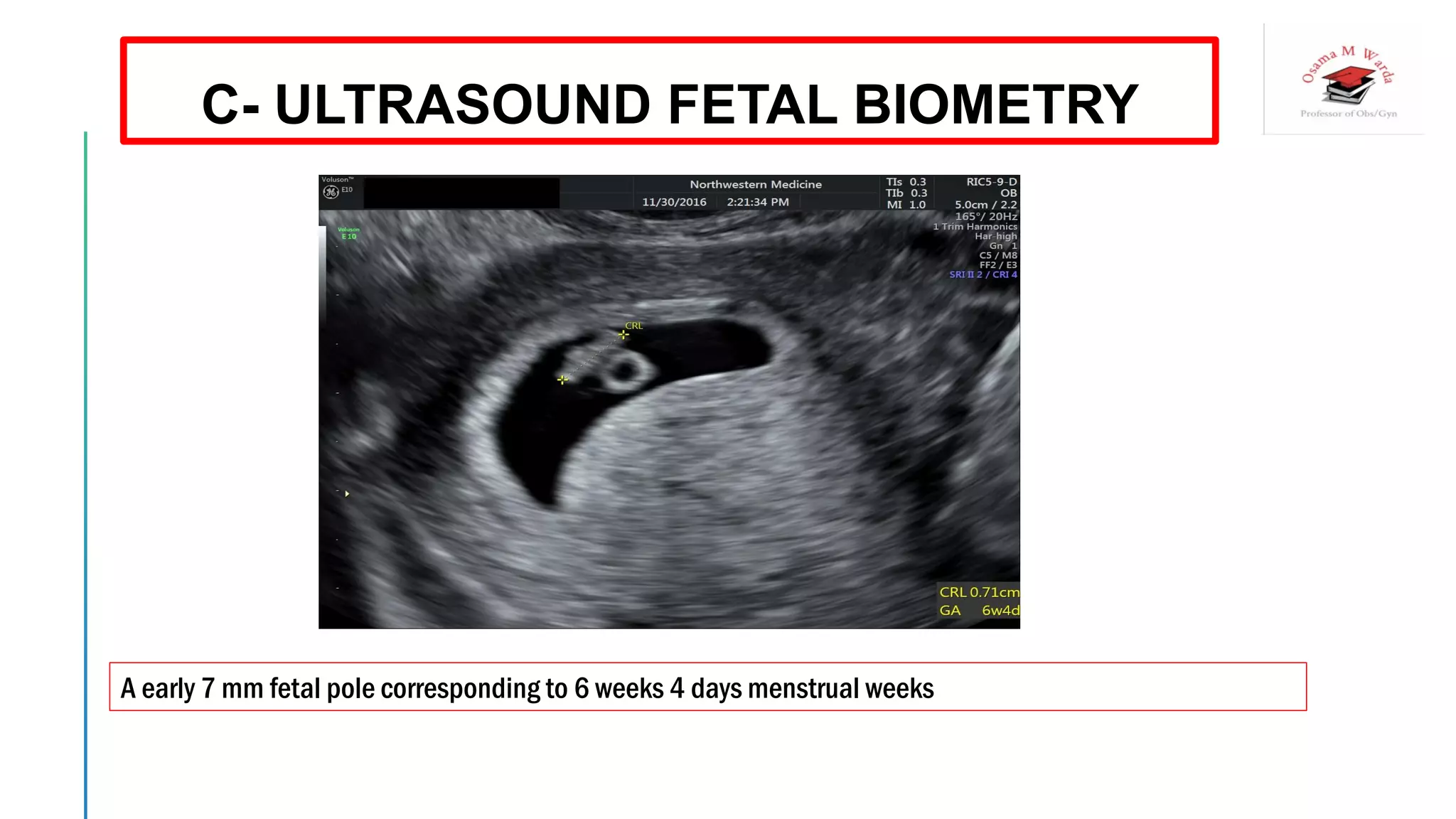 A early 7 mm fetal pole corresponding to 6 weeks 4 days menstrual weeks
C- ULTRASOUND FETAL BIOMETRY
 