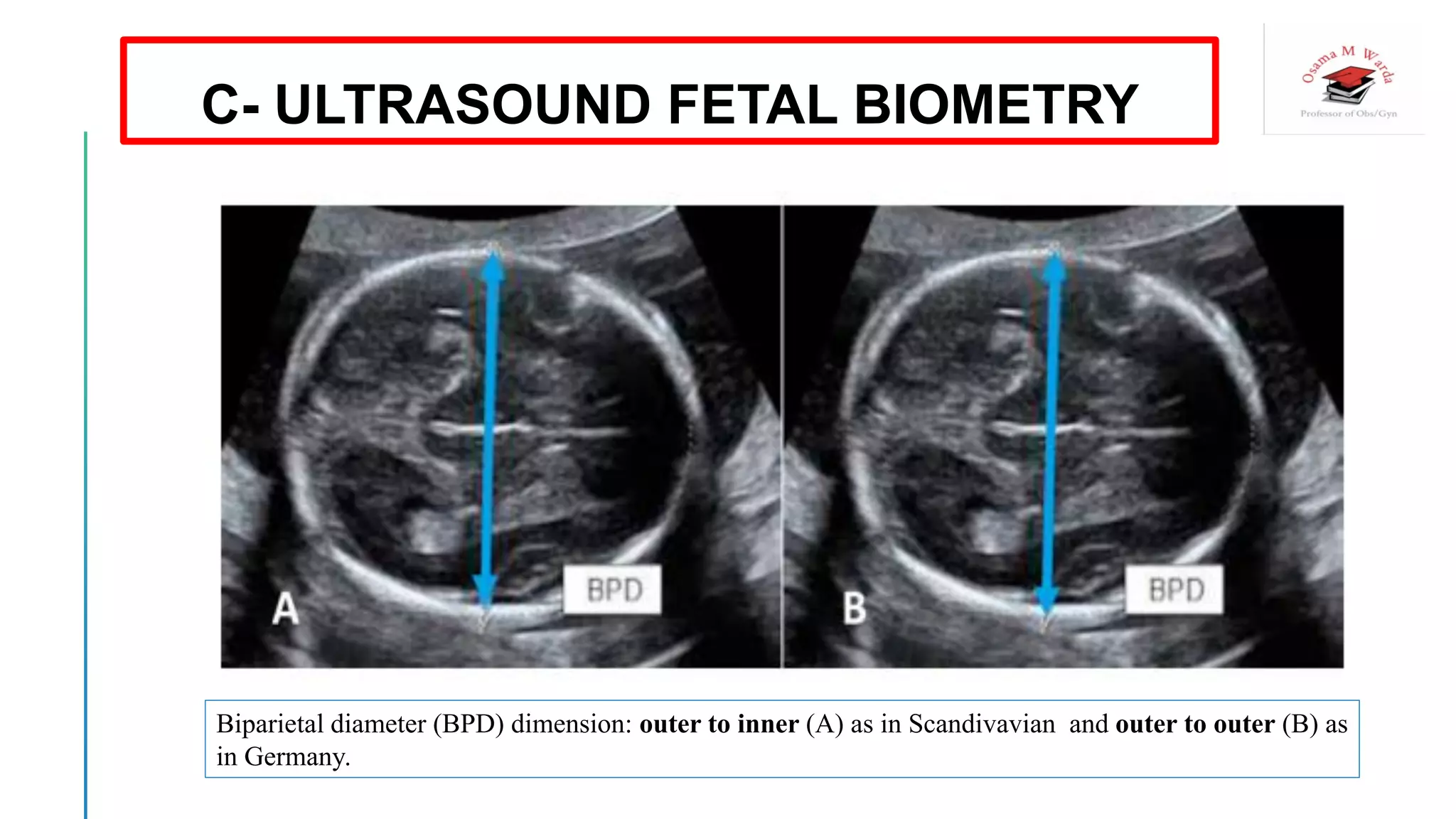 Biparietal diameter (BPD) dimension: outer to inner (A) as in Scandivavian and outer to outer (B) as
in Germany.
C- ULTRASOUND FETAL BIOMETRY
 