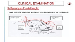 CLINICAL EXAMINATION
3- Symphysis Fundal hieght:
 