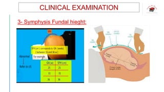 CLINICAL EXAMINATION
3- Symphysis Fundal hieght:
 