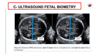Biparietal diameter (BPD) dimension: outer to inner (A) as in Scandivavian and outer to outer (B) as
in Germany.
C- ULTRASOUND FETAL BIOMETRY
 