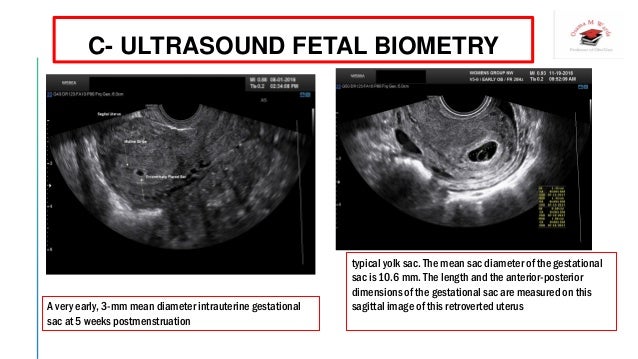 Age ultrasound gestational to determine