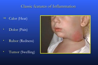 Classic features of Inflammation

¢   Calor (Heat)

•   Dolor (Pain)

•   Rubor (Redness)

•   Tumor (Swelling)
 