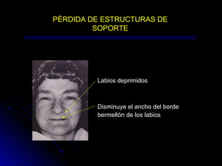PÉRDIDA DE ESTRUCTURAS DE
SOPORTE
Disminuye el ancho del borde
bermellón de los labios
Labios deprimidos
 