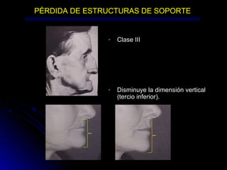 PÉRDIDA DE ESTRUCTURAS DE SOPORTE
- Clase III
- Disminuye la dimensión vertical
(tercio inferior).
 
