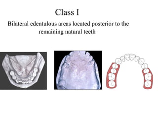 Class I
Bilateral edentulous areas located posterior to the
remaining natural teeth
 