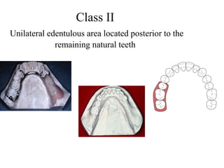 Class II
Unilateral edentulous area located posterior to the
remaining natural teeth
 