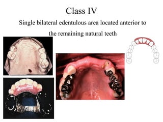 Class IV
Single bilateral edentulous area located anterior to
the remaining natural teeth
 