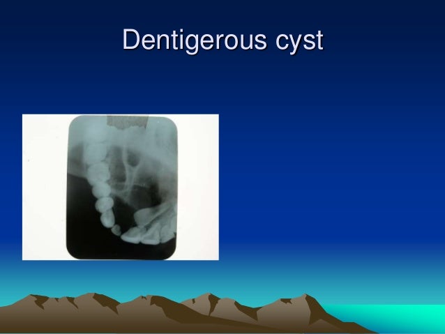 1 intro to cyst, classification & pathophysiology