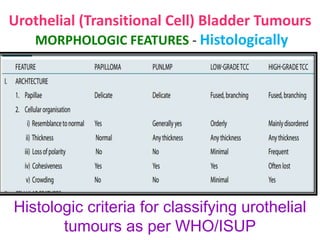 Urothelial (Transitional Cell) Bladder Tumours
MORPHOLOGIC FEATURES - Histologically
Histologic criteria for classifying urothelial
tumours as per WHO/ISUP
 