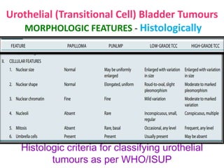 Urothelial (Transitional Cell) Bladder Tumours
MORPHOLOGIC FEATURES - Histologically
Histologic criteria for classifying urothelial
tumours as per WHO/ISUP
 