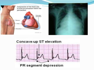 Management of pericarditis
 Pericardiocentesis : a therapeutic procedure to
remove fluid from the pericardium (to relief
...