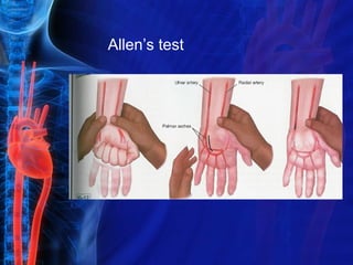 Koutouzis M - AIMRADIAL 2015 - Transradial and negative Allen test | PPT